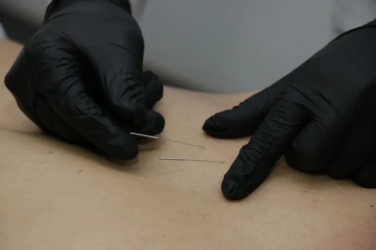 Mãos com luvas pretas posicionando agulhas finas de dry needling sobre a pele do paciente
